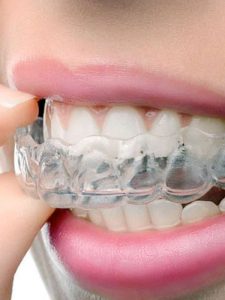 Dental Mouth Guard