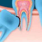 Wisdom Teeth Extraction Wisdom Teeth Extraction