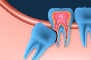 Wisdom Teeth Extraction