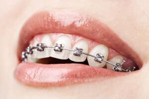 Dental Braces Brampton