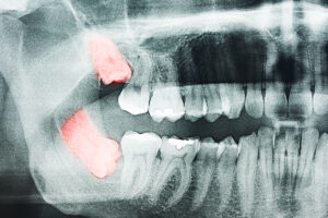 Wisdom Teeth Removal in Brampton