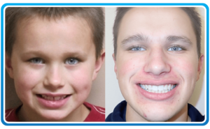 Braces Before After 2-min