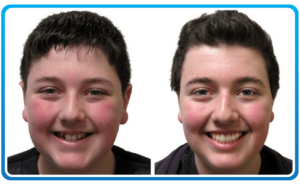 Braces Before After 3-min