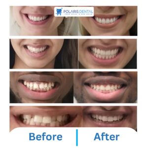 Orthodontic Braces Brampton