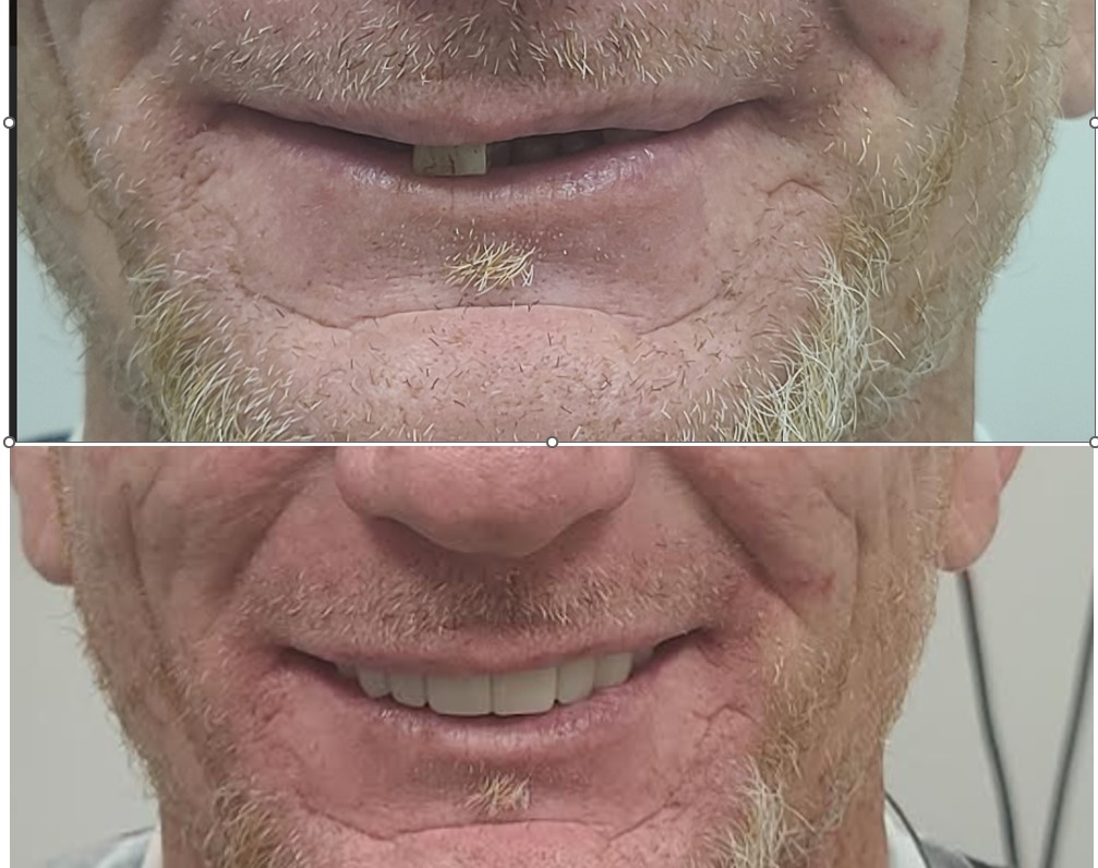 Snap-On Smile Veneers - Polaris Dental