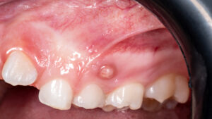 swollen gums