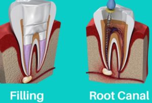 root canal