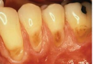 abrasion teeth