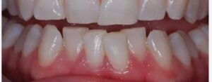 lower teeth crowding