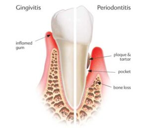 gigivitis vs periodontitis