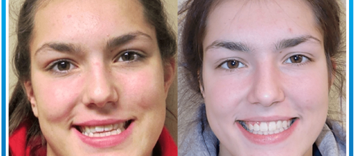 Braces Before After-min