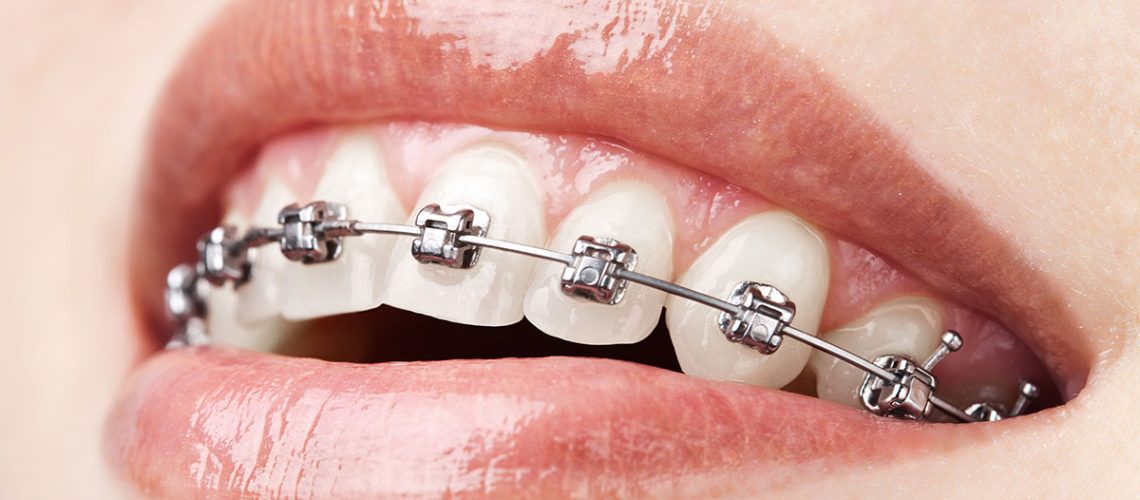 Dental Braces Brampton