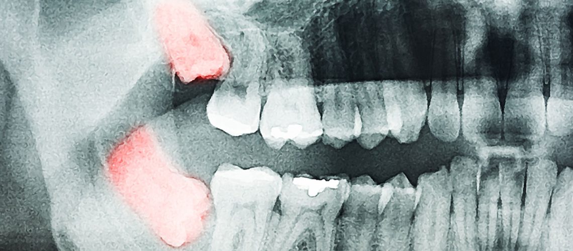 Wisdom Teeth Removal in Brampton