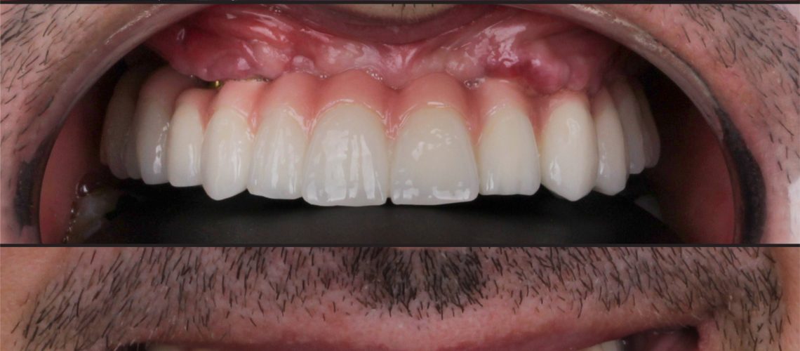 All-on-four,Implant,Treatment.,Visuals,Of,Aesthetic,Smile,Design,With,Porcelain
