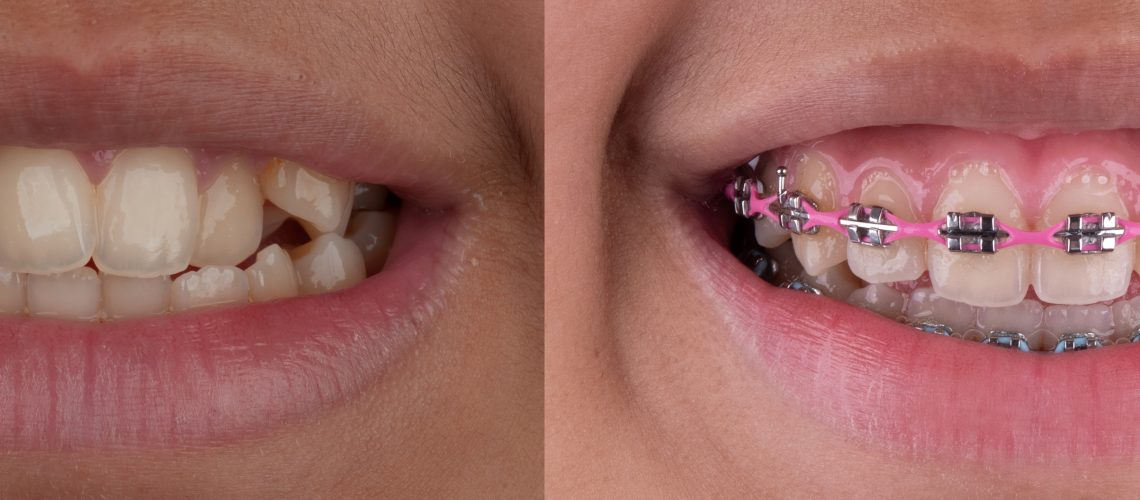 Smile,Of,Metal,Braces,Treatment,,Conventional,Bracket,And,Metal,Wire