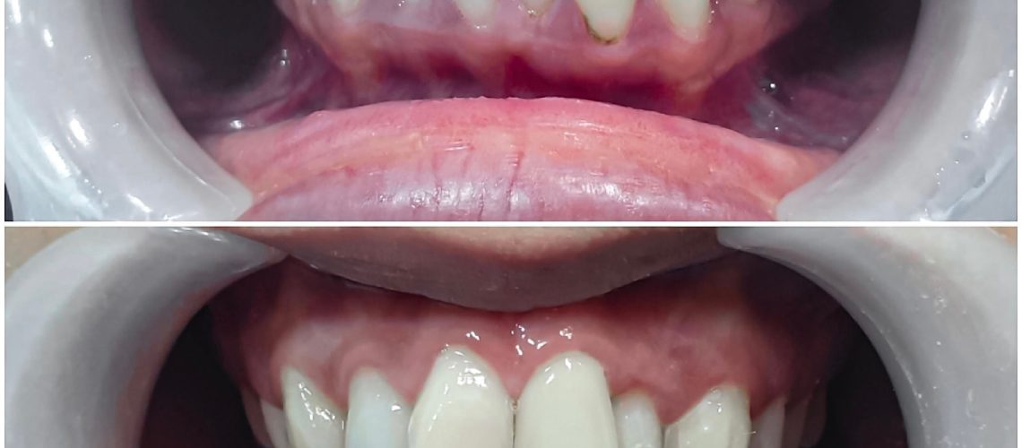 A successful dental restoration, highlighting the transformation of a cracked and broken front tooth after repair.
