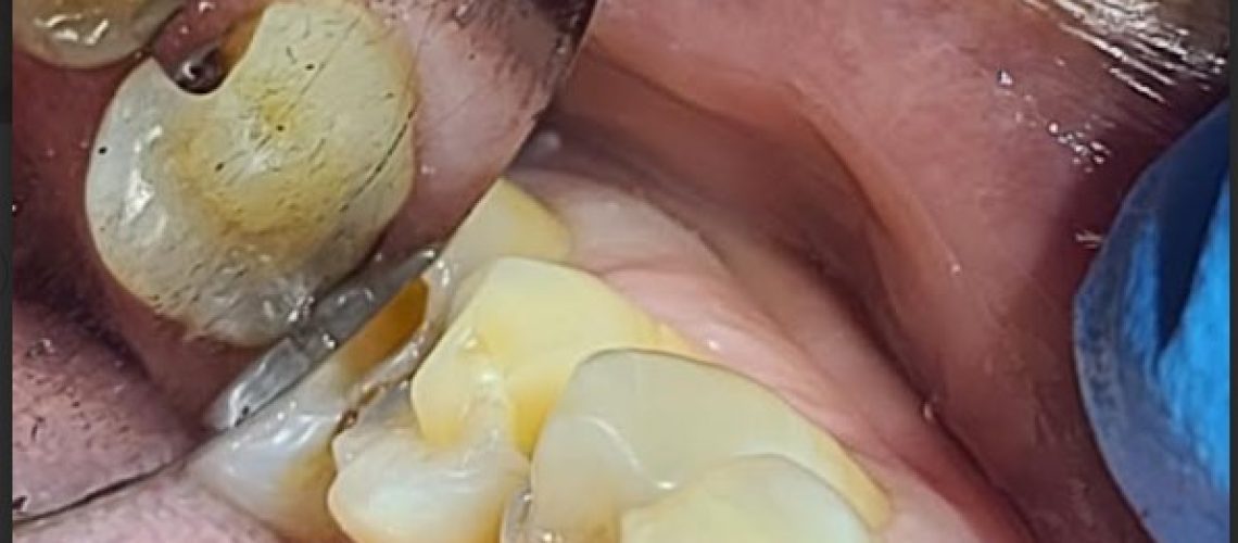 cracked tooth treatment