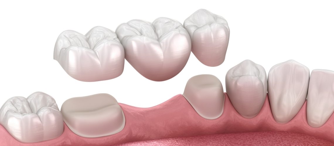 dental bridge ceramic