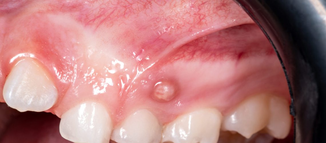 swollen gums