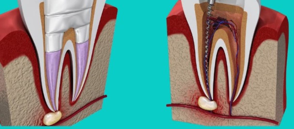root canal