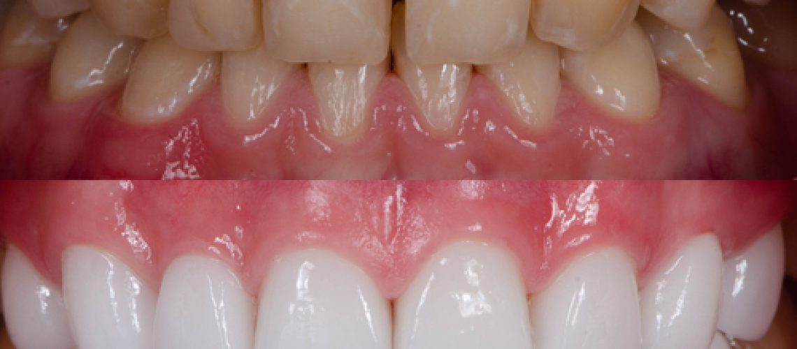 porcelain veneers